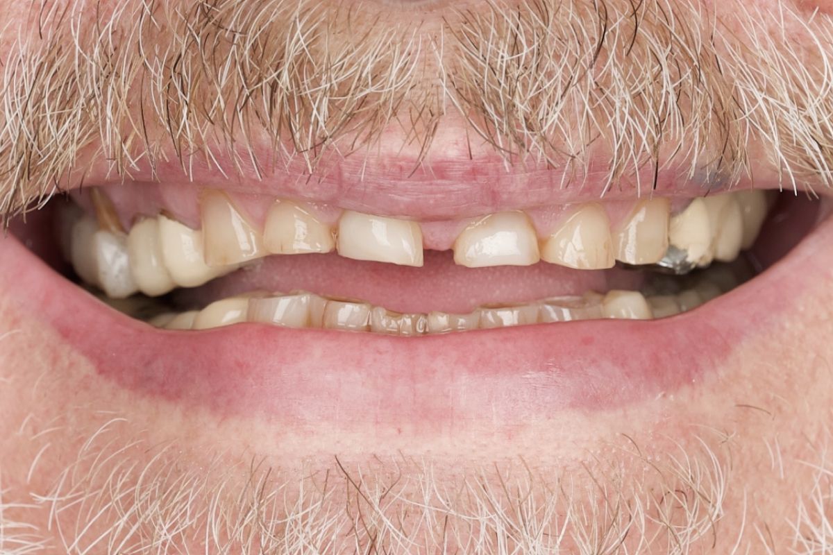 After image